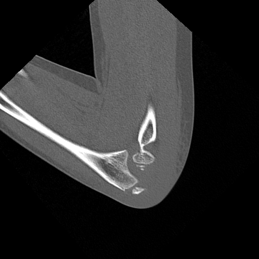 Medial Epicondyle Avulsion Fracture Image Radiopaedia Org