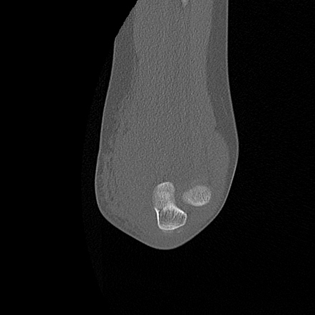 Medial Epicondyle Avulsion Fracture Image Radiopaedia Org