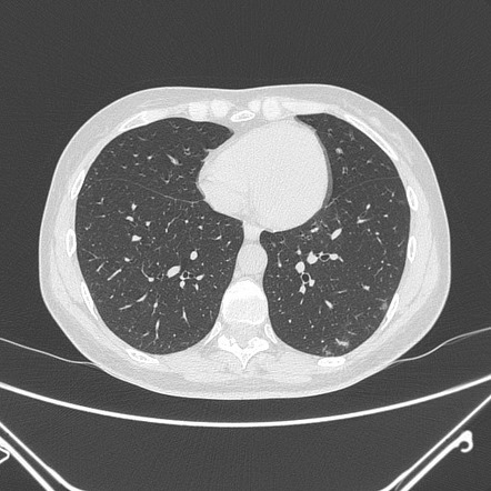 Ground-glass Opacification | Radiology Reference Article | Radiopaedia.org