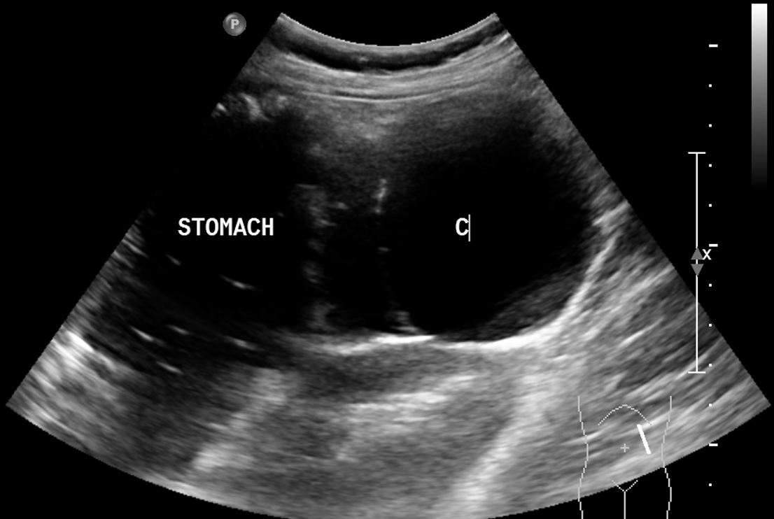 Mucinous Cystadenoma Of The Pancreas Image