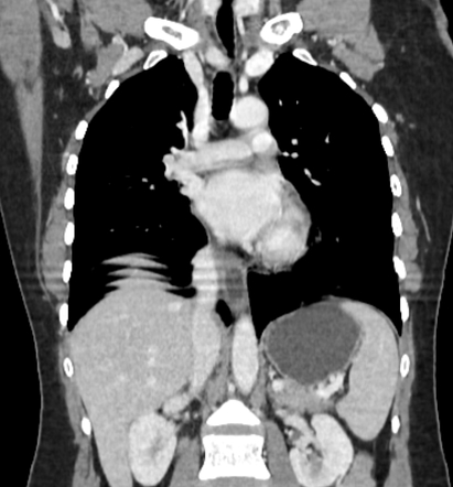 Gastric band | Radiology Reference Article | Radiopaedia.org