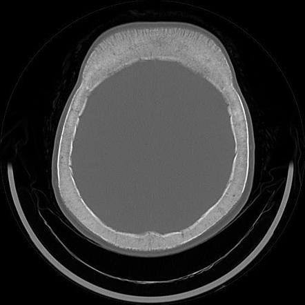 Widening of the diploic space | Radiology Reference Article ...