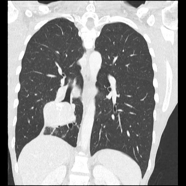 Bronchial carcinoid tumor | Radiology Reference Article | Radiopaedia.org