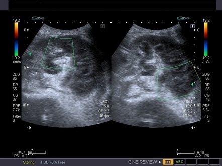 Renal transplant torsion | Radiology Reference Article | Radiopaedia.org