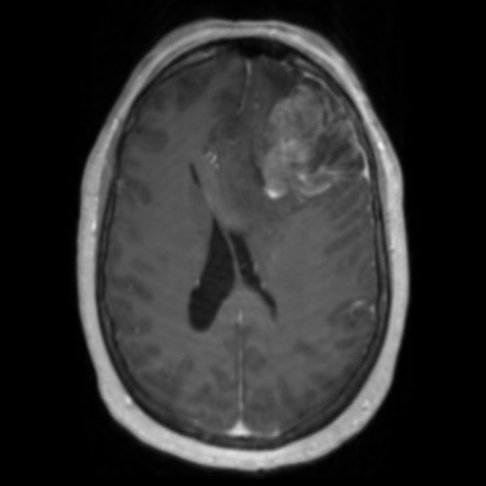 Anaplastic oligodendroglioma | Radiology Reference Article ...