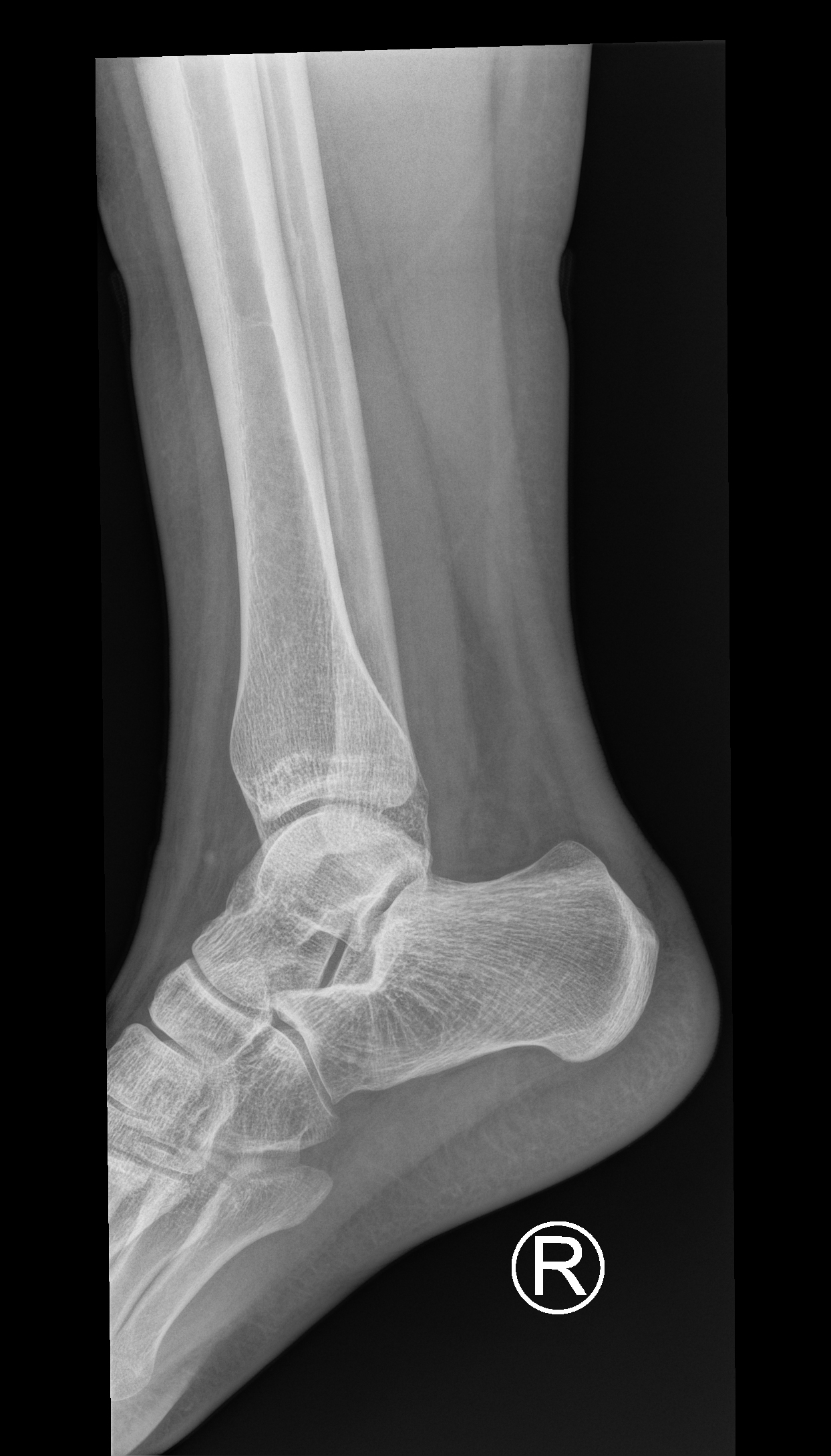 Distal fibular stress injury | Image | Radiopaedia.org