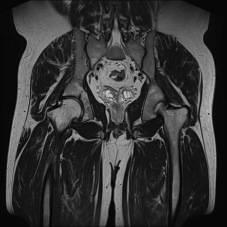 Acetabular fracture | Image | Radiopaedia.org