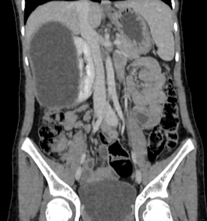 Renal hydatid cyst - pediatric | Image | Radiopaedia.org