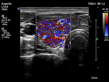 Thyroid inferno | Radiology Reference Article | Radiopaedia.org