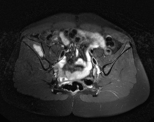 Subperiosteal hematoma of the iliac bone | Image | Radiopaedia.org