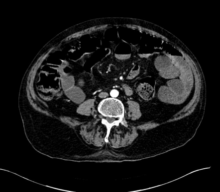 Cholangiocarcinoma with cerebral metastases | Image | Radiopaedia.org