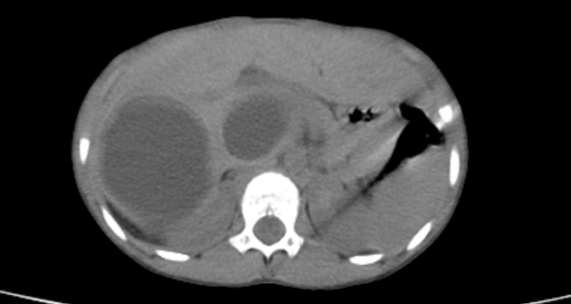 Hepatic Hydatid Cysts Pediatric Radiology Case Radiopaedia Org