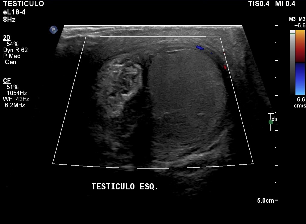 Testicular Torsion Image