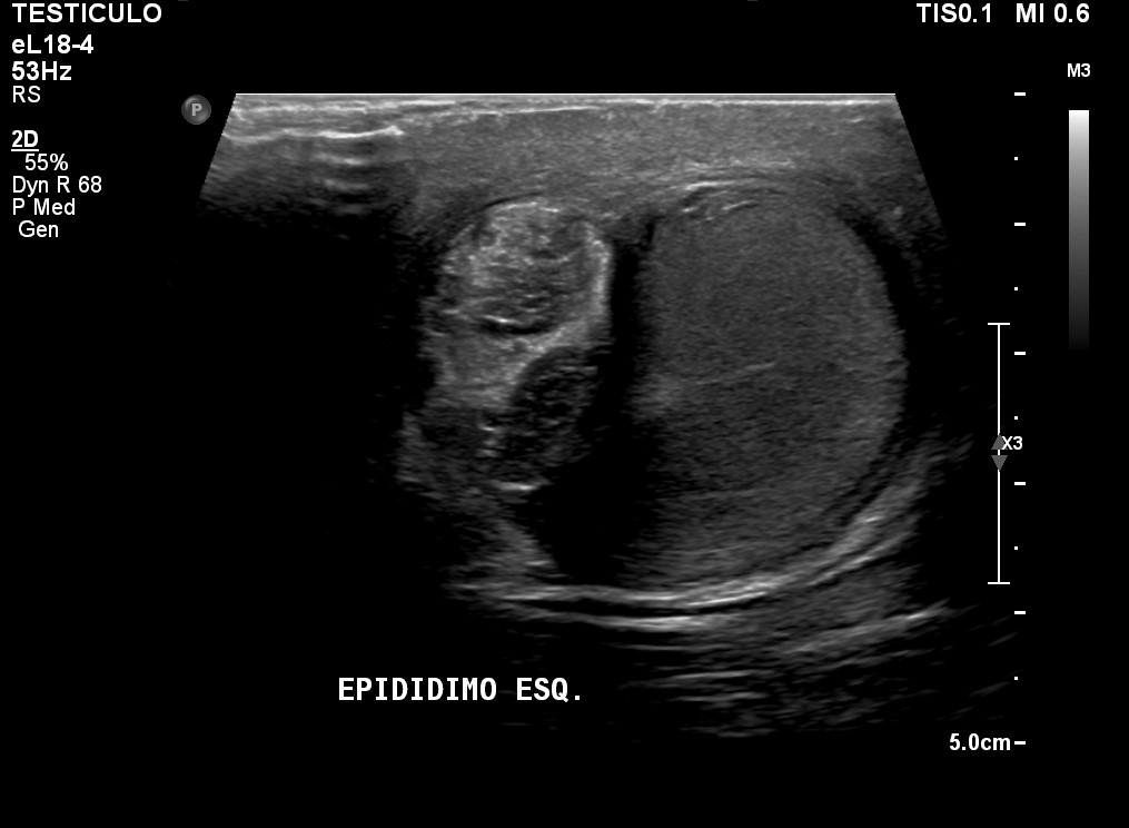 Testicular Torsion Image