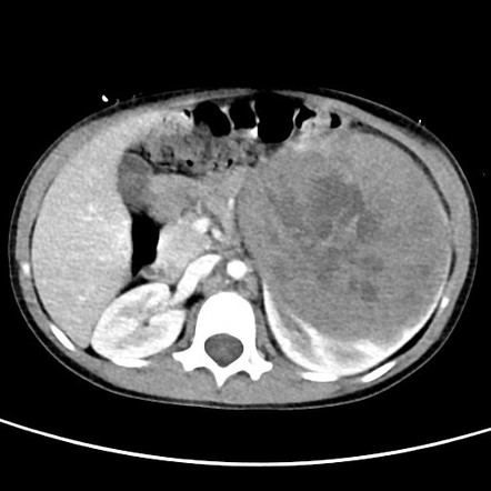 Claw sign (mass) | Radiology Reference Article | Radiopaedia.org