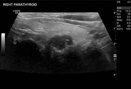 Hyperparathyroidism | Radiology Reference Article | Radiopaedia.org