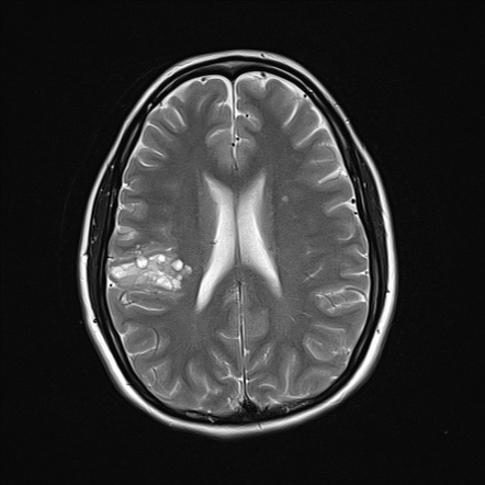 Ganglioglioma | Radiology Reference Article | Radiopaedia.org