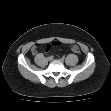 Epiploic appendagitis | Radiology Case | Radiopaedia.org