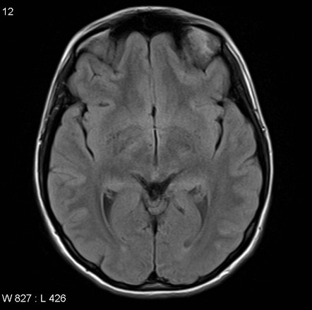 Ganglioglioma | Image | Radiopaedia.org