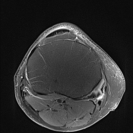 Semimembranosus tendinopathy | Radiology Case | Radiopaedia.org