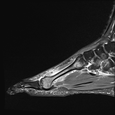 Freiberg infraction - acute | Image | Radiopaedia.org