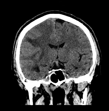 Cholangiocarcinoma with cerebral metastases | Image | Radiopaedia.org