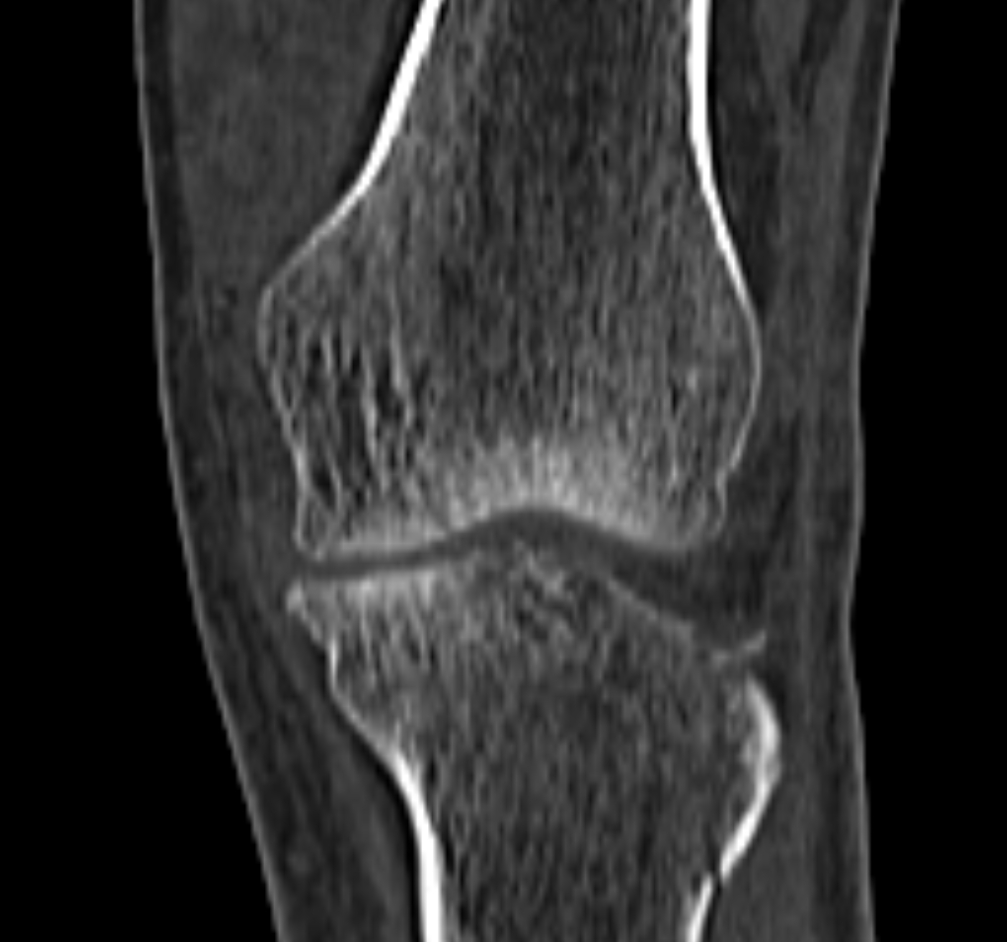 Schatzker type II fracture | Image | Radiopaedia.org