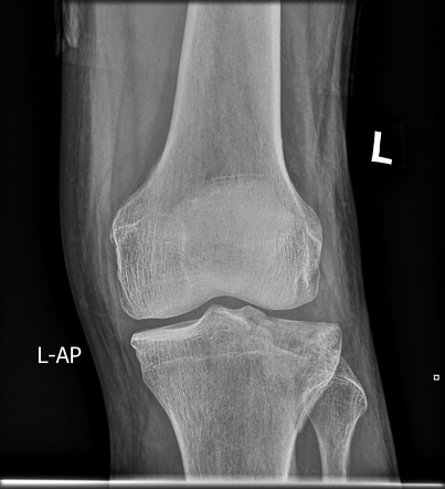 Schatzker type II fracture | Radiology Case | Radiopaedia.org