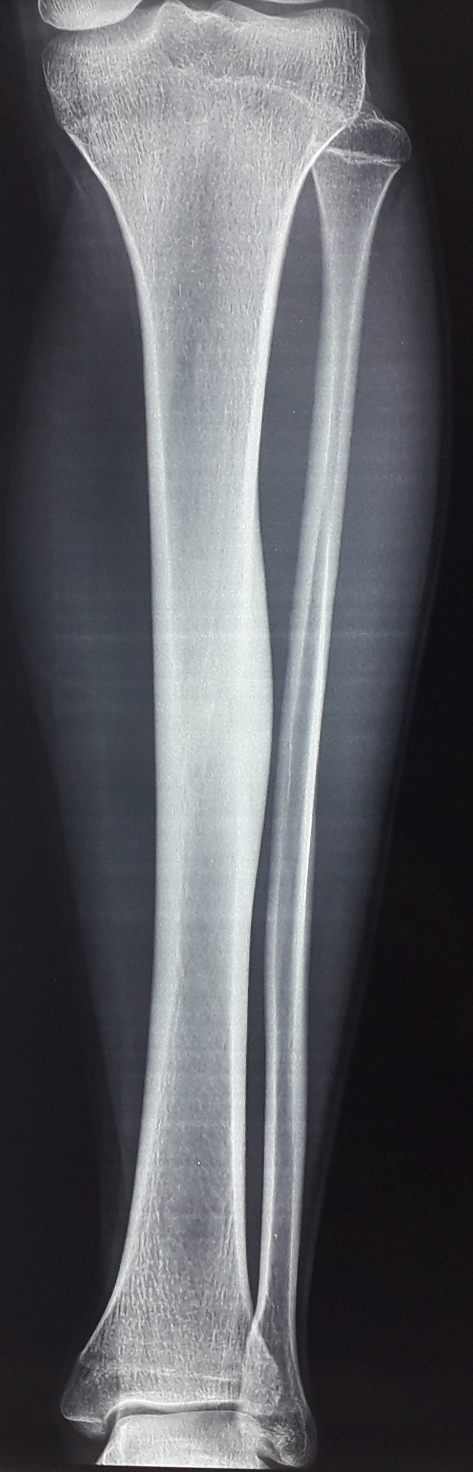 osteoid osteoma of tibia | Image | Radiopaedia.org