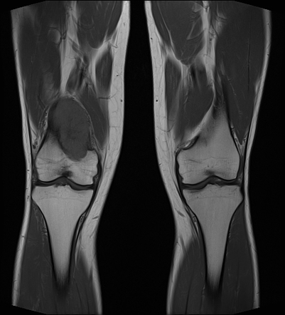 Aneurysmal bone cyst | Radiology Case | Radiopaedia.org