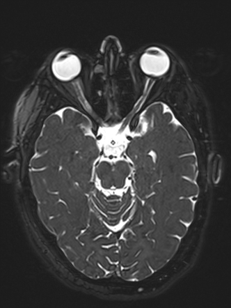 Idiopathic intracranial hypertension | Image | Radiopaedia.org