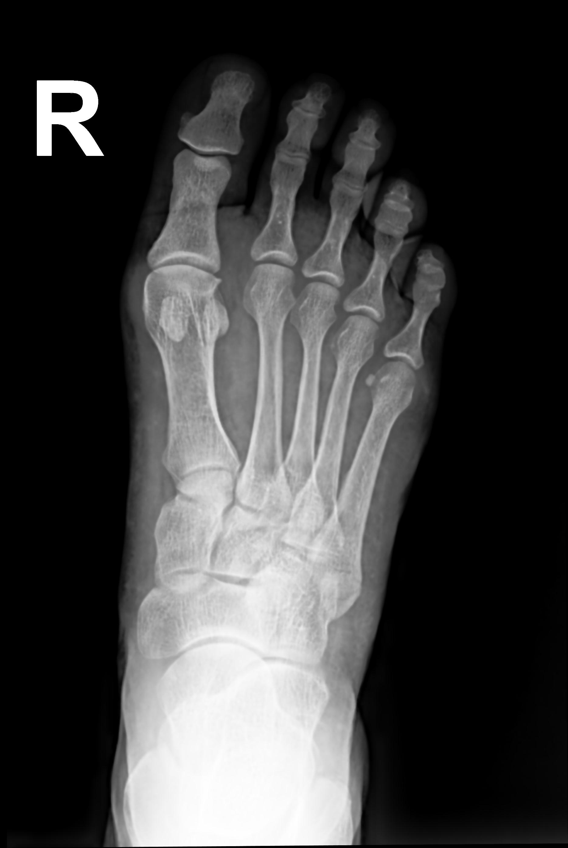 Fifth metatarsal avulsion fracture | Image | Radiopaedia.org