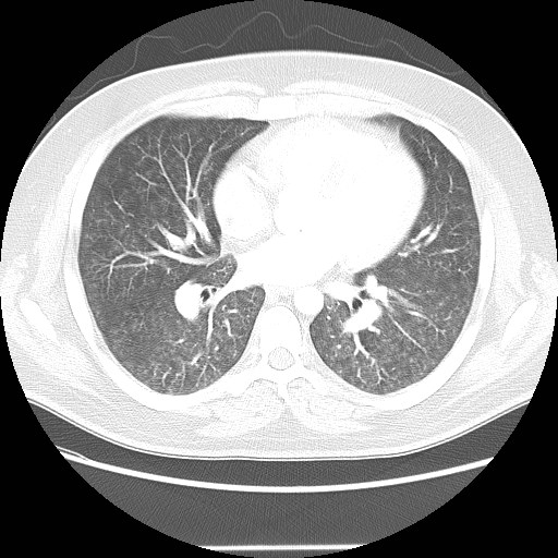 Pulmonary capillary haemangiomatosis | Image | Radiopaedia.org