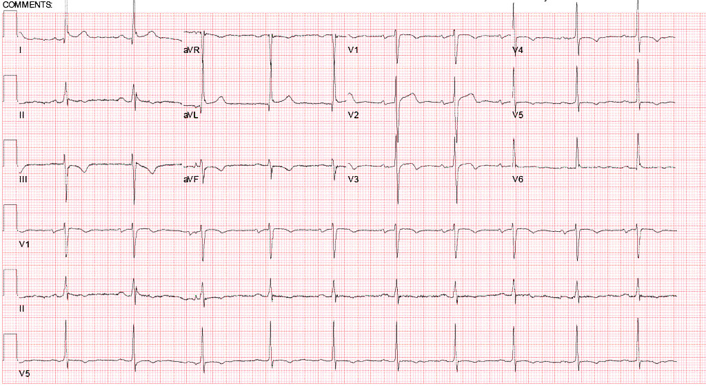 Ischemia