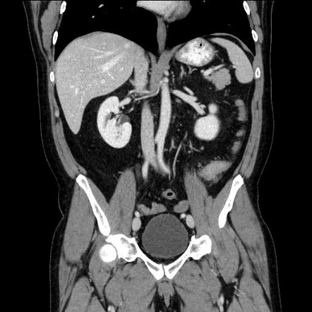 Colonic perforation from grill brush bristle | Image | Radiopaedia.org