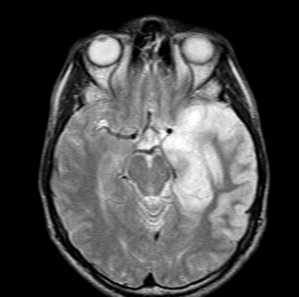 Radiology Quiz 26529 | Radiopaedia.org | Playlist 'encephalitis' by 