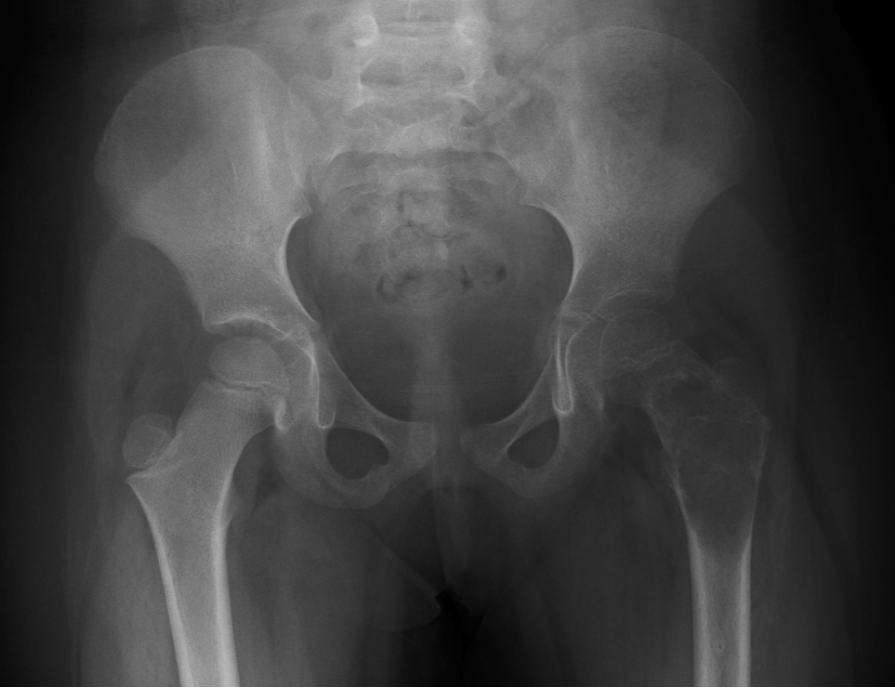 Unicameral bone cyst - left proximal femur | Image | Radiopaedia.org