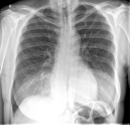 Breast prostheses | Radiology Case | Radiopaedia.org