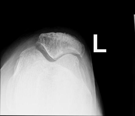 bilateral bipartite patella icd 10