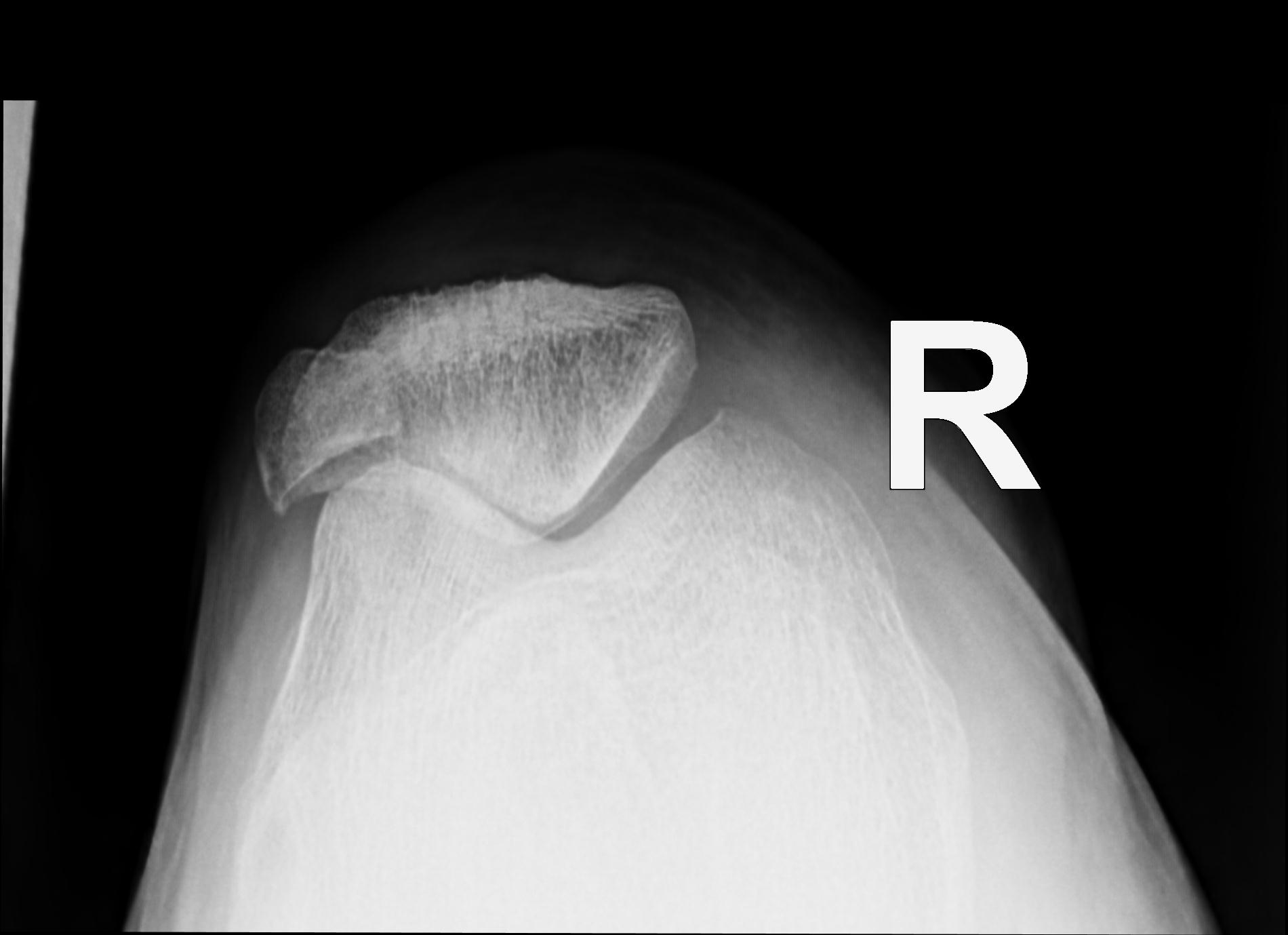 Bipartite patella - bilateral | Image | Radiopaedia.org