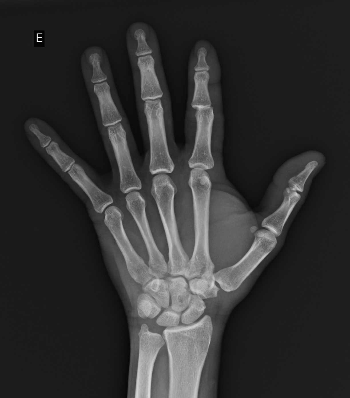 Interphalangeal joint dislocation | Image | Radiopaedia.org