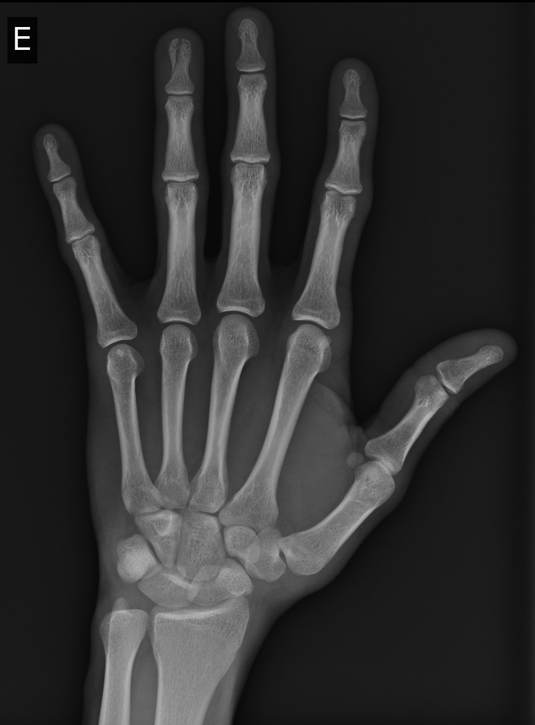 Tuft fracture of the distal phalanx | Image | Radiopaedia.org