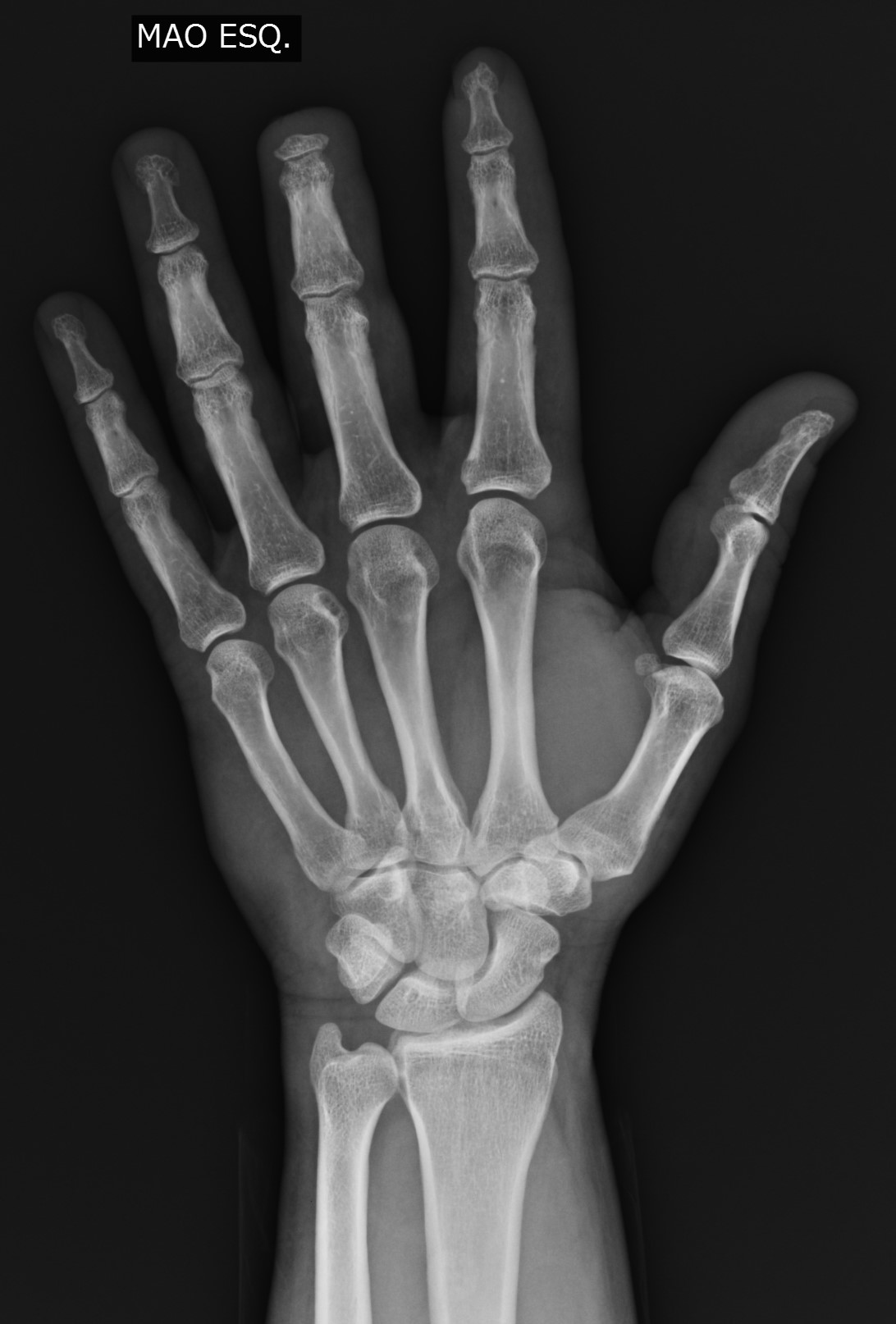 Traumatic amputation of the distal phalanx | Image | Radiopaedia.org