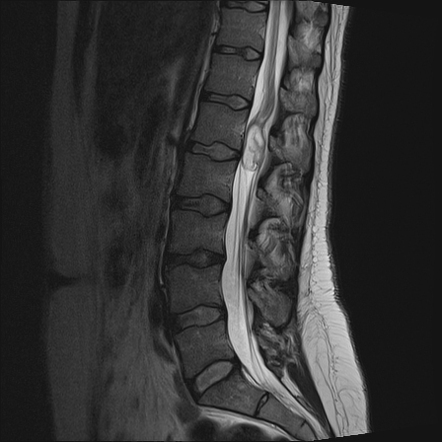 Cystic teratoma of the conus | Radiology Case | Radiopaedia.org