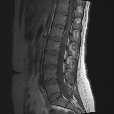 Spinal schwannoma | Radiology Reference Article | Radiopaedia.org