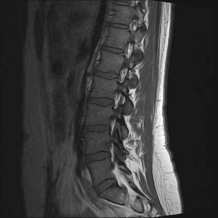 Neoplasms of the cauda equina (differential) | Radiology Reference ...