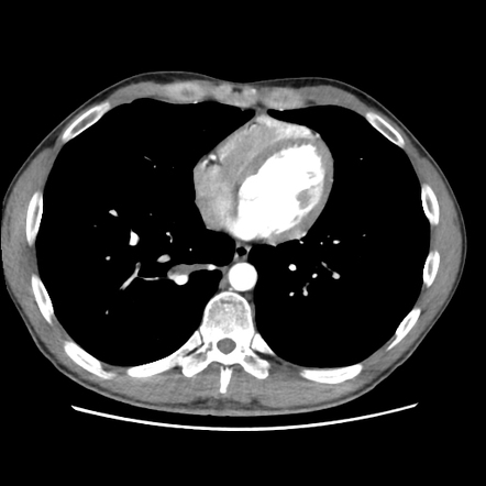 Pulmonary sequestration and bronchial atresia | Radiology Case ...