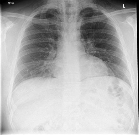 Spontaenous pneumomediastinum | Radiology Case | Radiopaedia.org