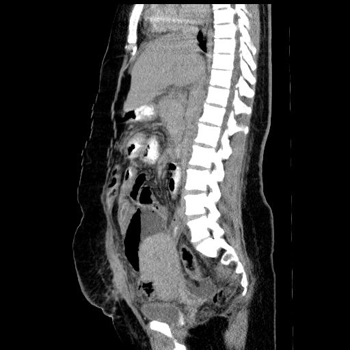 Uterine suture dehiscence and abscess formation | Image | Radiopaedia.org