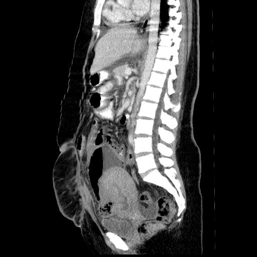 Uterine suture dehiscence and abscess formation | Image | Radiopaedia.org